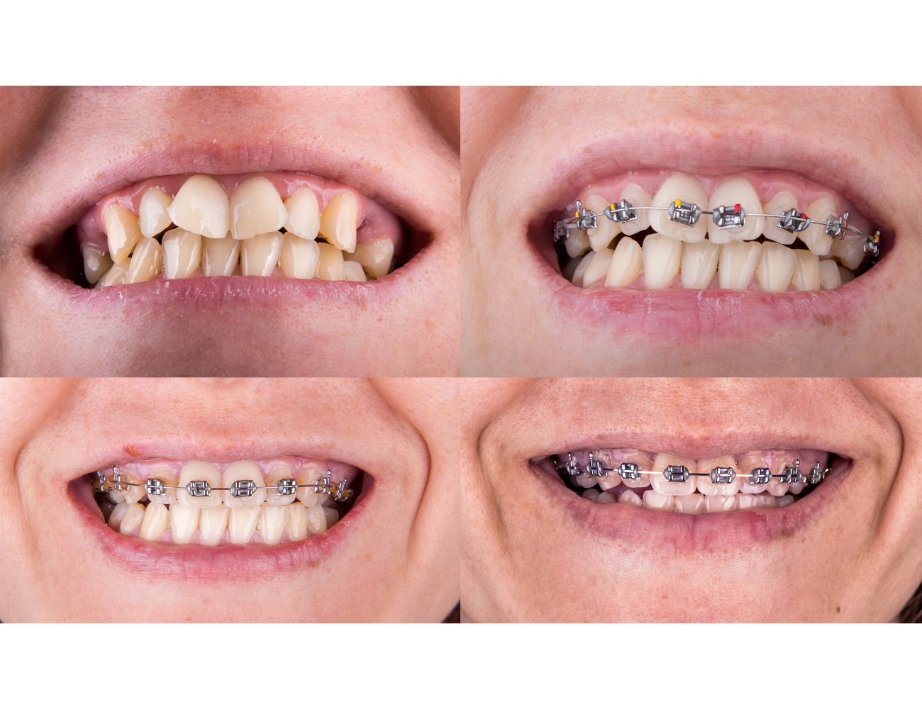 Smile Makeover Result